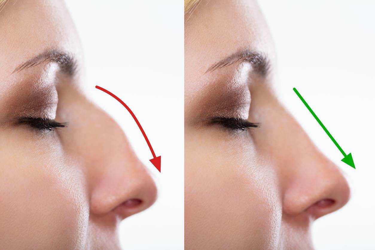 rhinoplastie de préservation