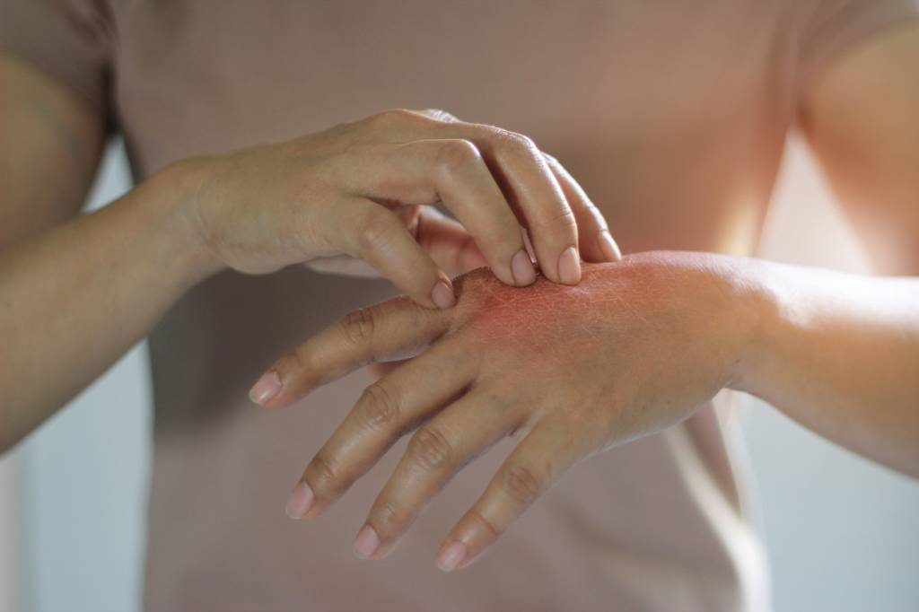 Psoriasis sur les mains 