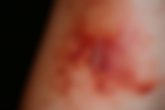 Photographie rapprochée d'une brûlure du deuxième degré en cours de guérison sur la peau humaine, montrant la texture brute, rouge et cloquée en détails cliniques, couleurs délavées, éclairage ambiant.