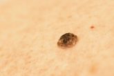 Photon d'une kératose séborrhéique