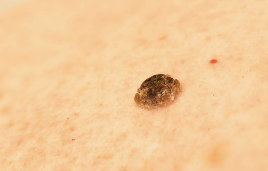 Photon d'une kératose séborrhéique