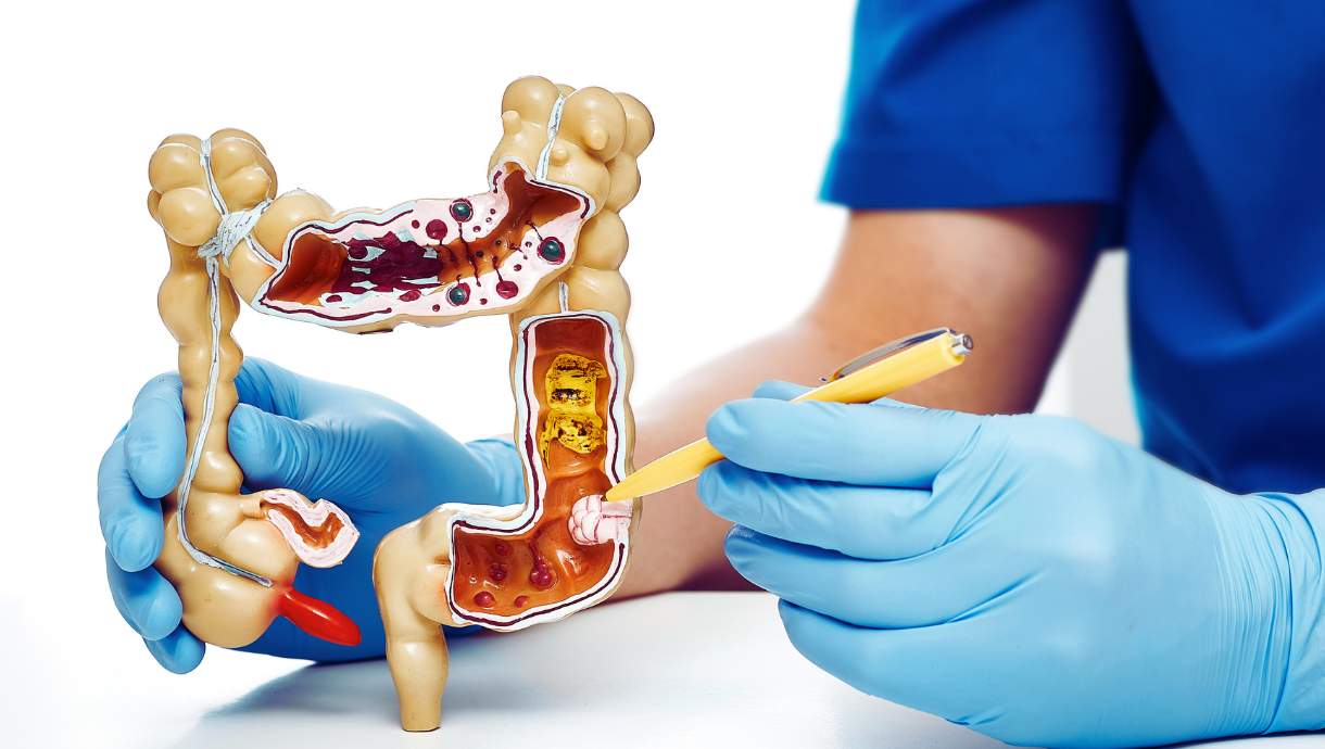 Quels sont les symptômes de la rectocolite