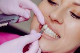 Un dentiste qui met une facette dentaire