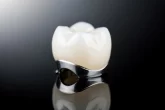 Couronne dentaire en céramo-métal posée sur une surface réfléchissante, mettant en valeur la porcelaine blanche et la structure métallique.
