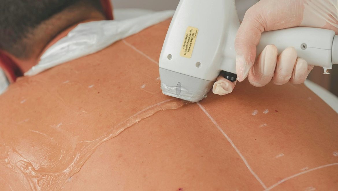 Praticien réalisant une épilation laser sur le dos d'un homme en cabinet